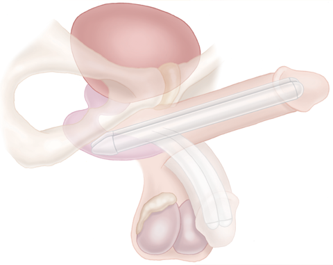 Illustration de la prothèse pénienne tactra.