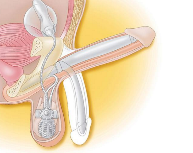 Implant pénien à 3 pièces