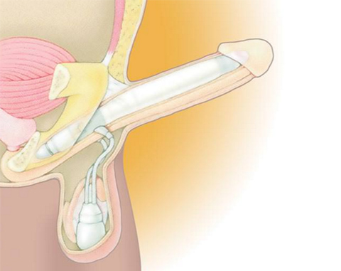 Implant pénien gonflable à 2 pièces