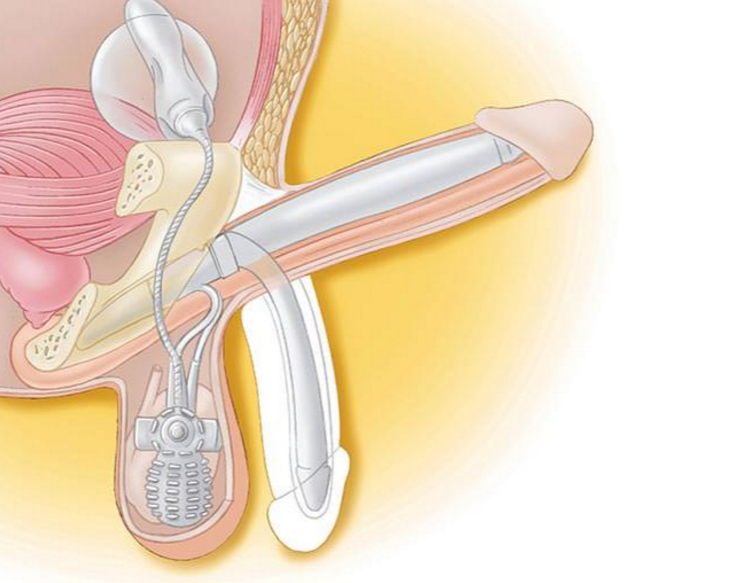 Illustration d'implant pénien trois pièces.